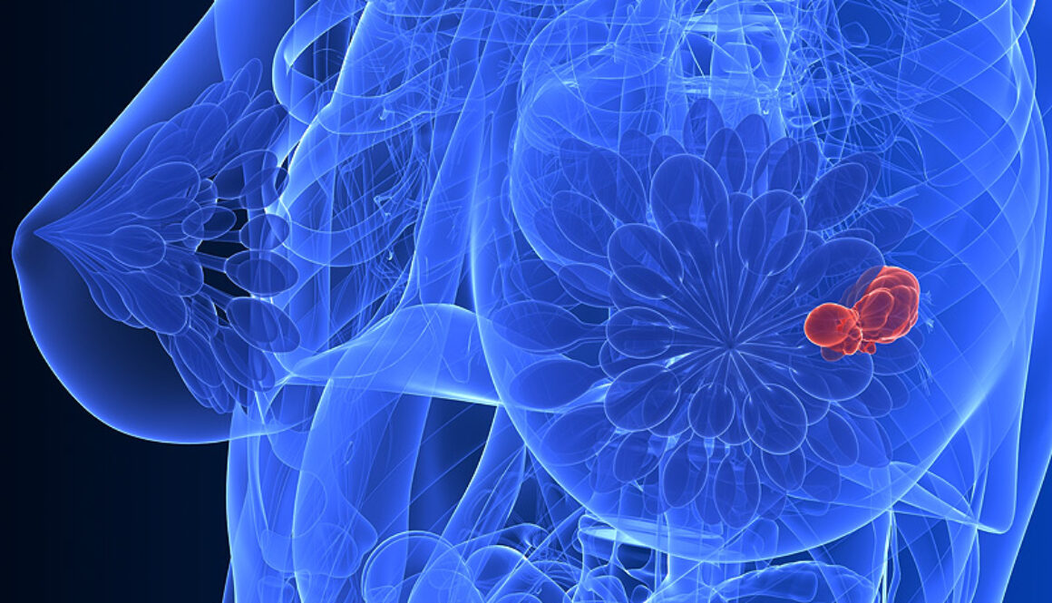 dt_150728_breast_cancer_tumor_800x600