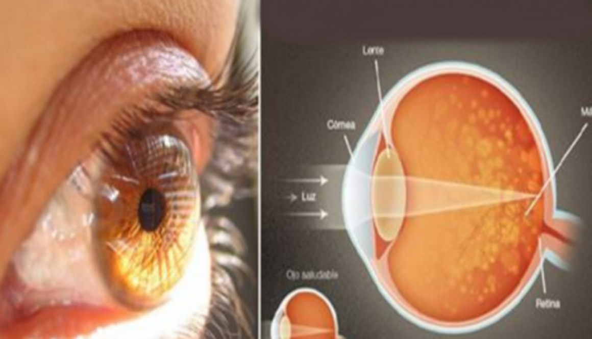 saffron macular degeneration
