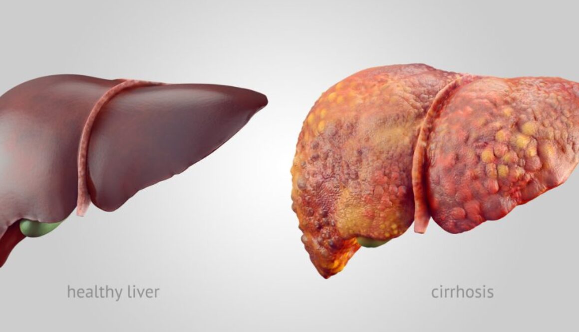 Health-_and_unhealthy_liver_1200x600