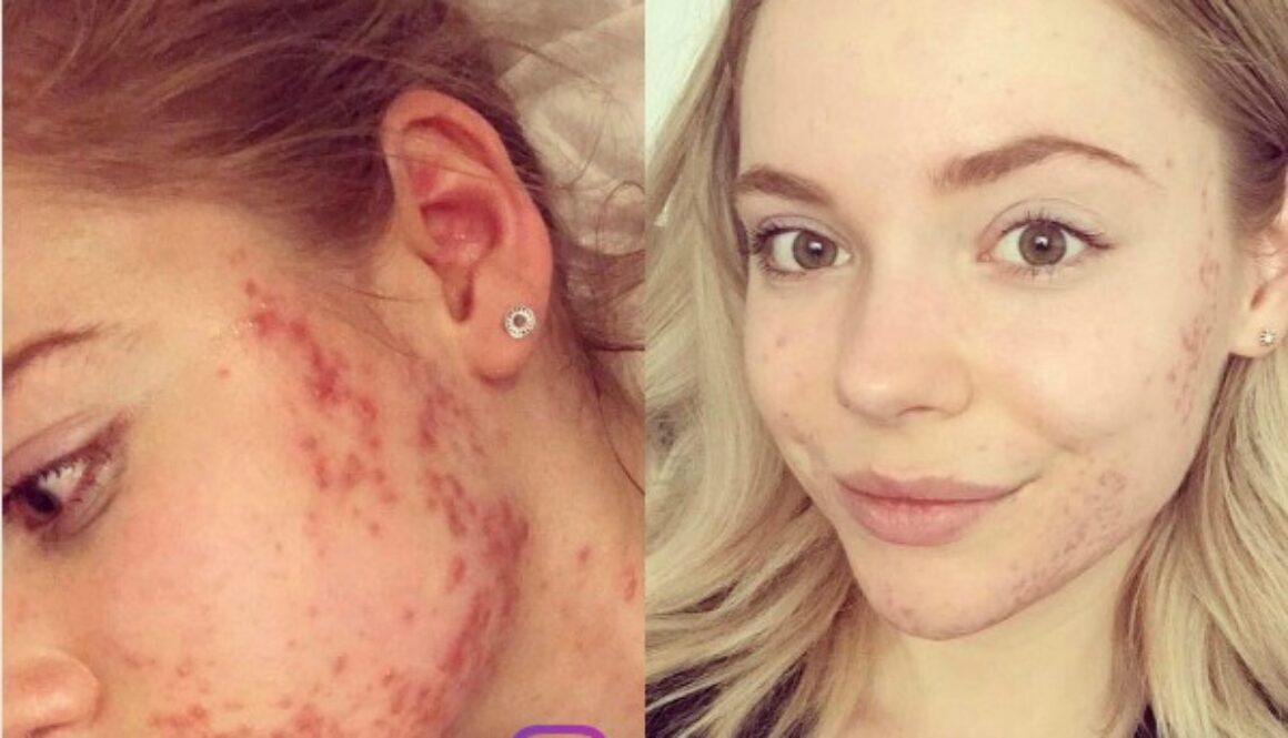 cystic acne diet before and after