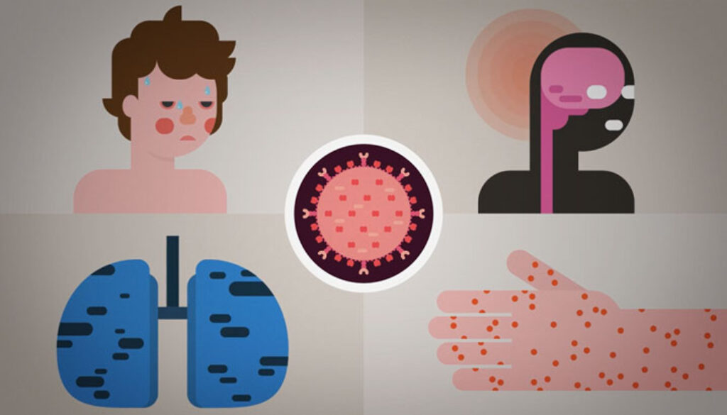 measles2