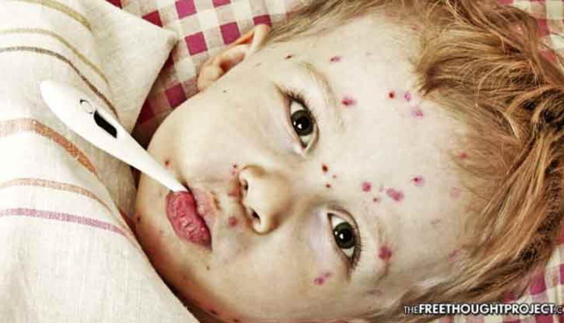 chickenpox