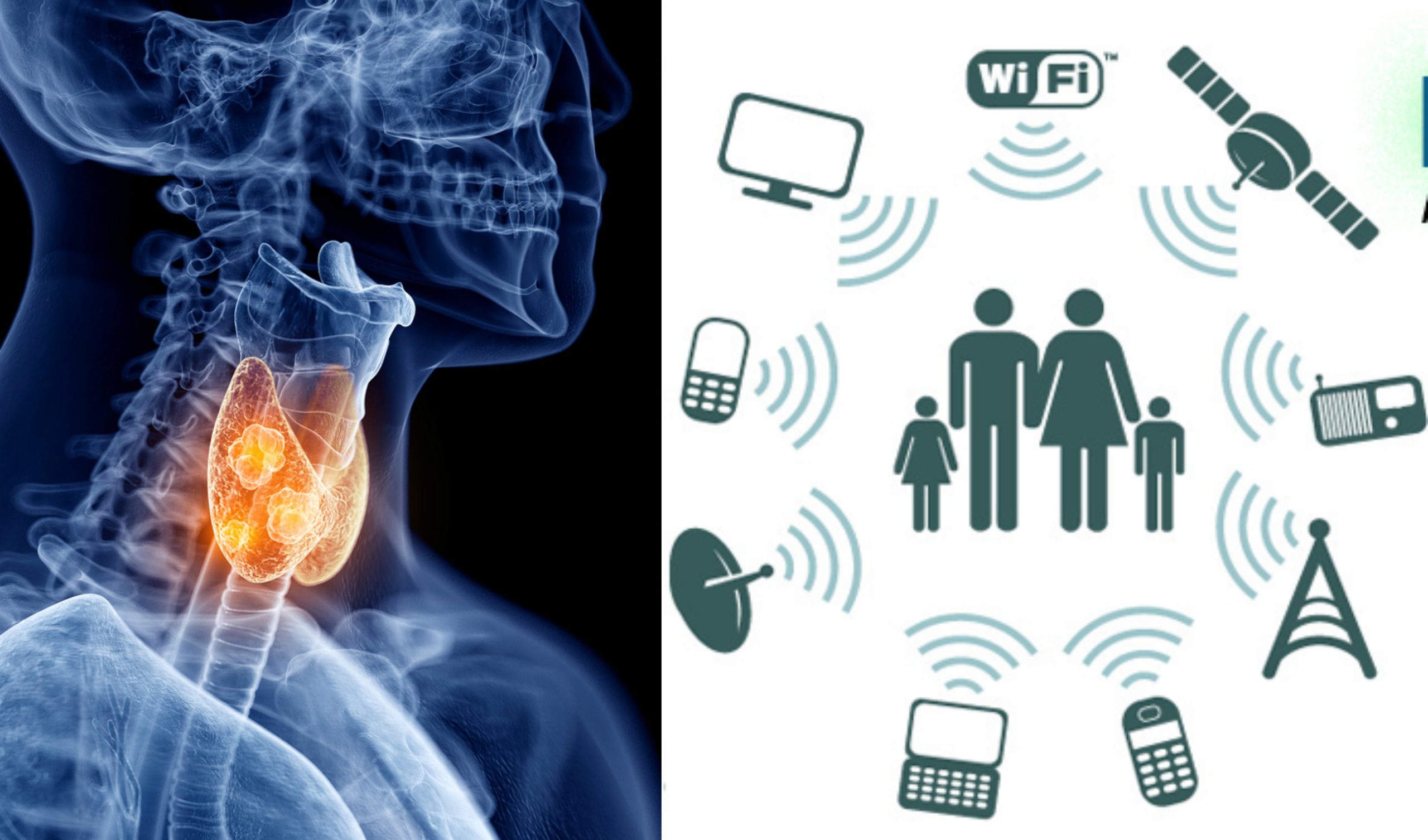 EMF autoimmune