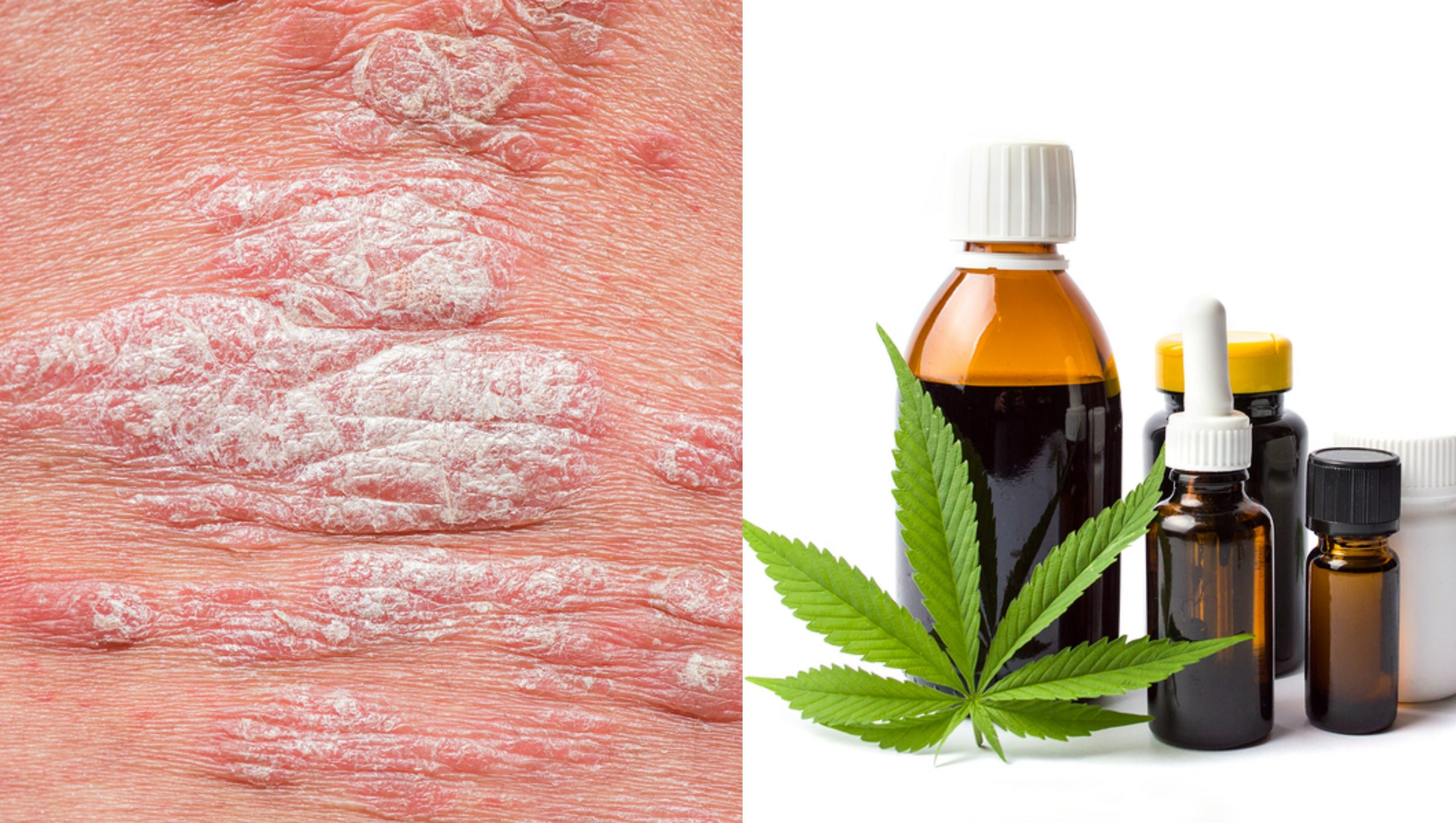 cbd psoriasis cure cbd psoriasis cure