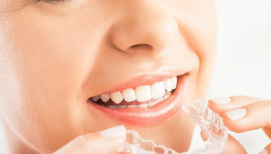 braces alternative