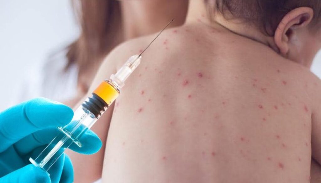 Measles-Vaccine-Kid