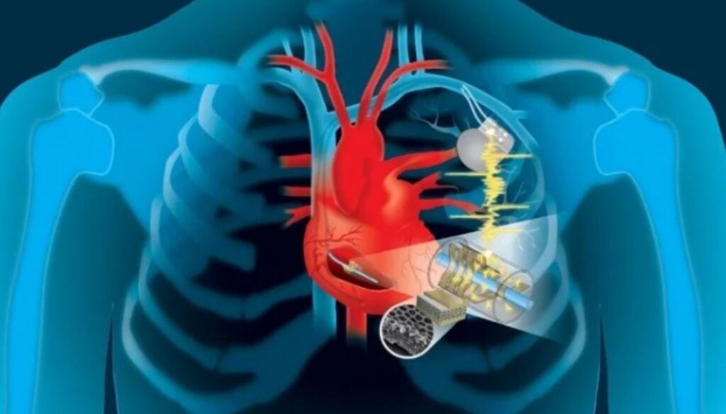 pacemaker