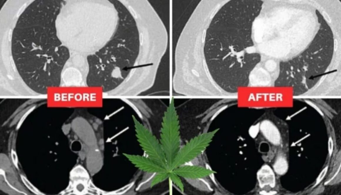 lung tumors cbd oil