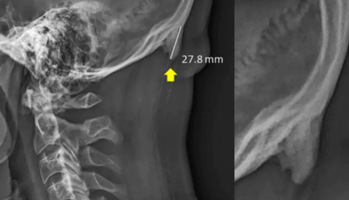 bone spur