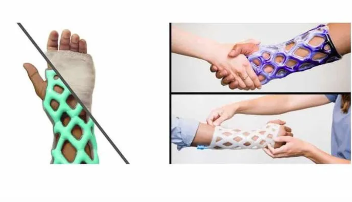Engineers-Create-A-Breathable-And-Waterproof-Cast-To-Replace-Plaster-Ones