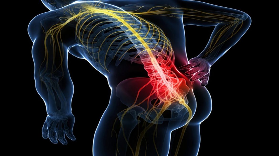 sciatica-3-1170x658 sciatica-3-1170x658