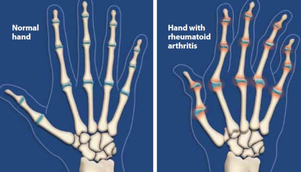 arthritis ce