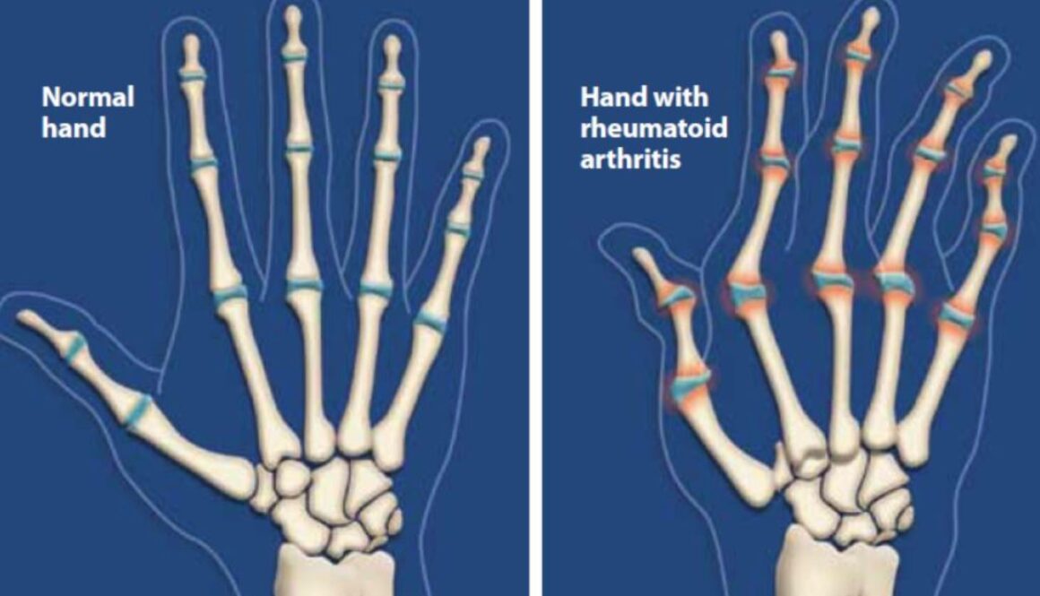 arthritis ce