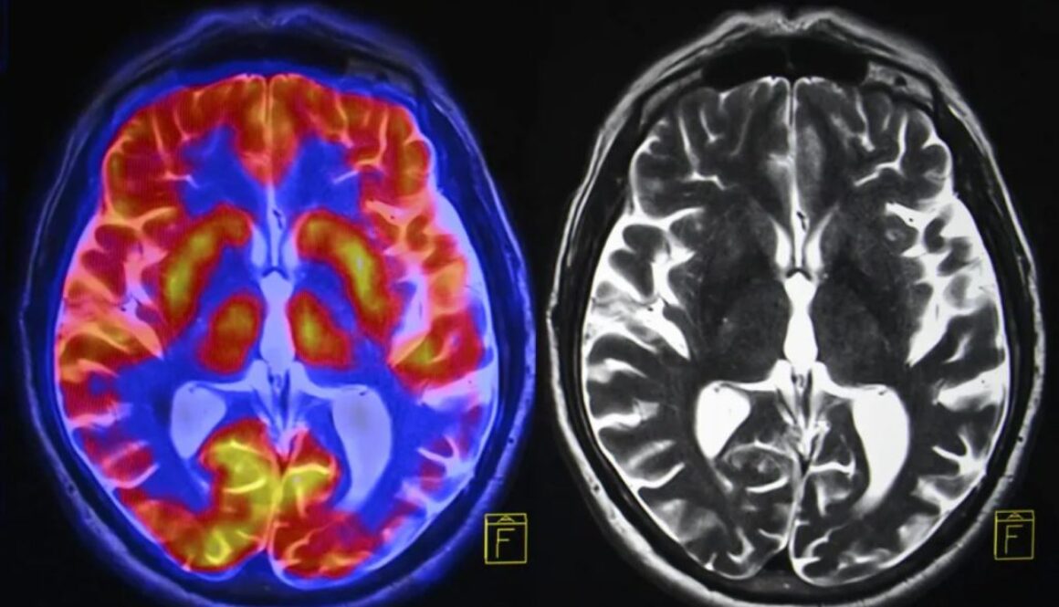 stress brain