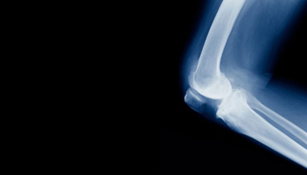 fracture gmi