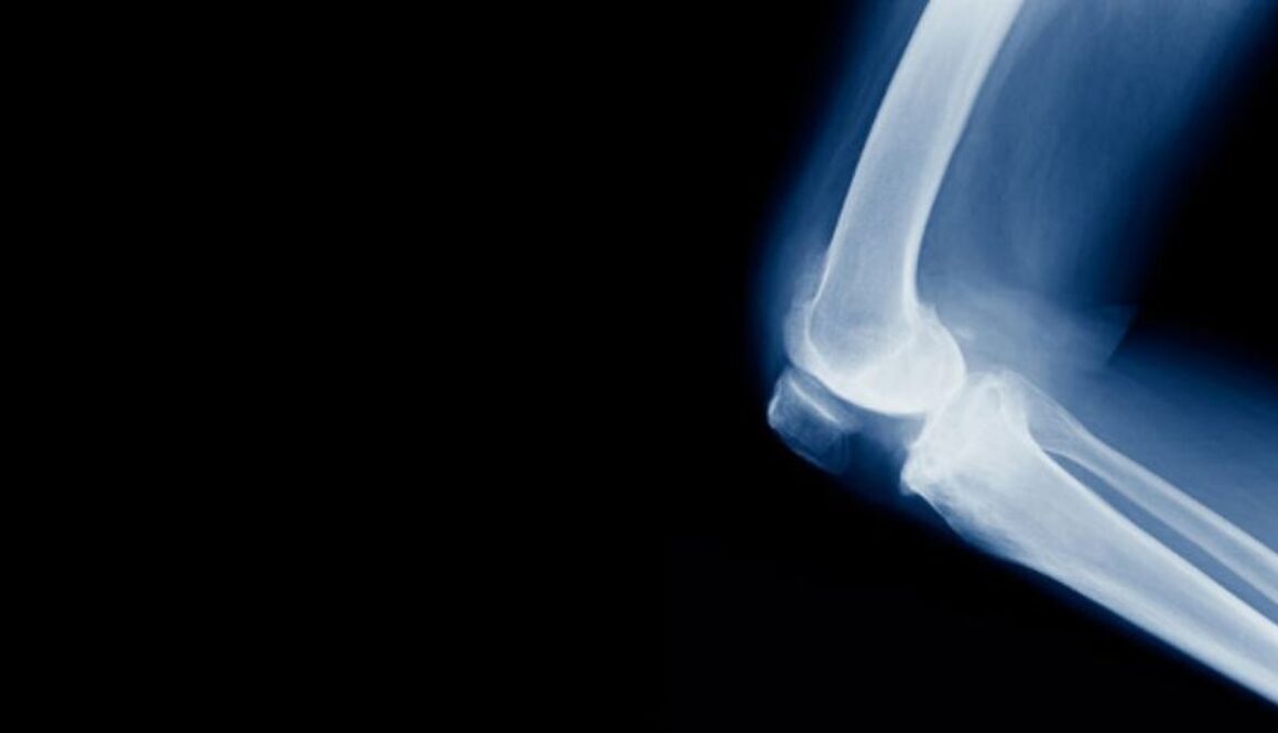 fracture gmi
