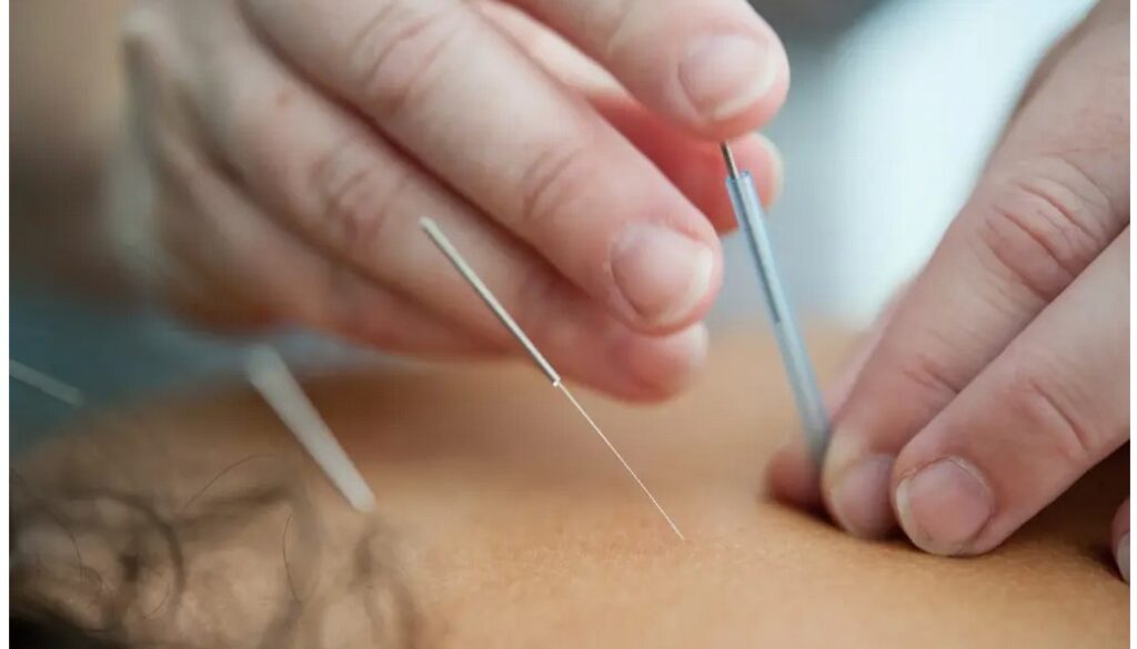 acupuncture unsplash