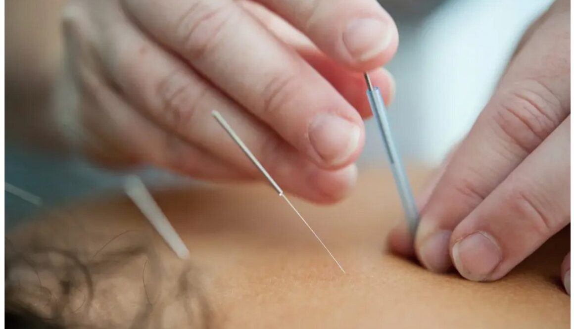 acupuncture unsplash