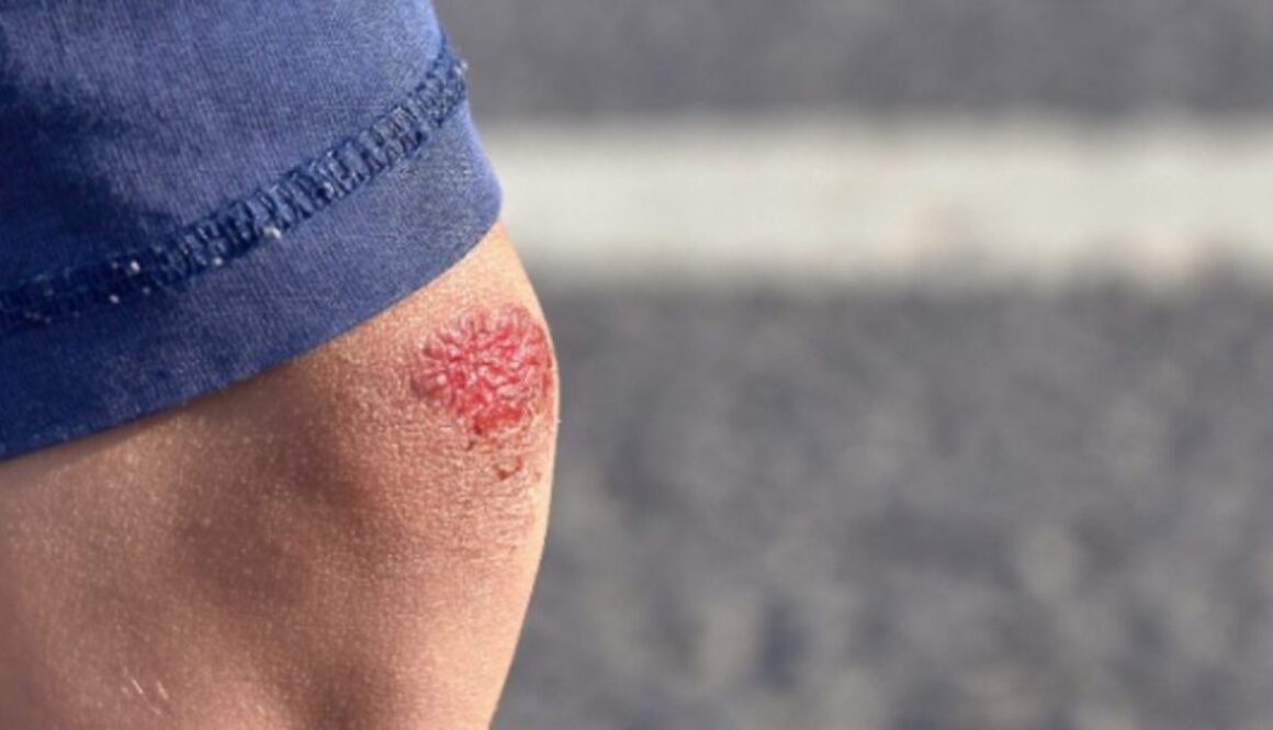 natural wound healing
