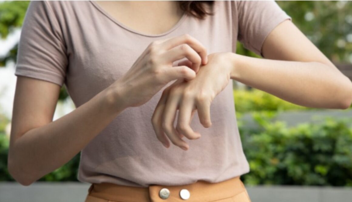 eczema