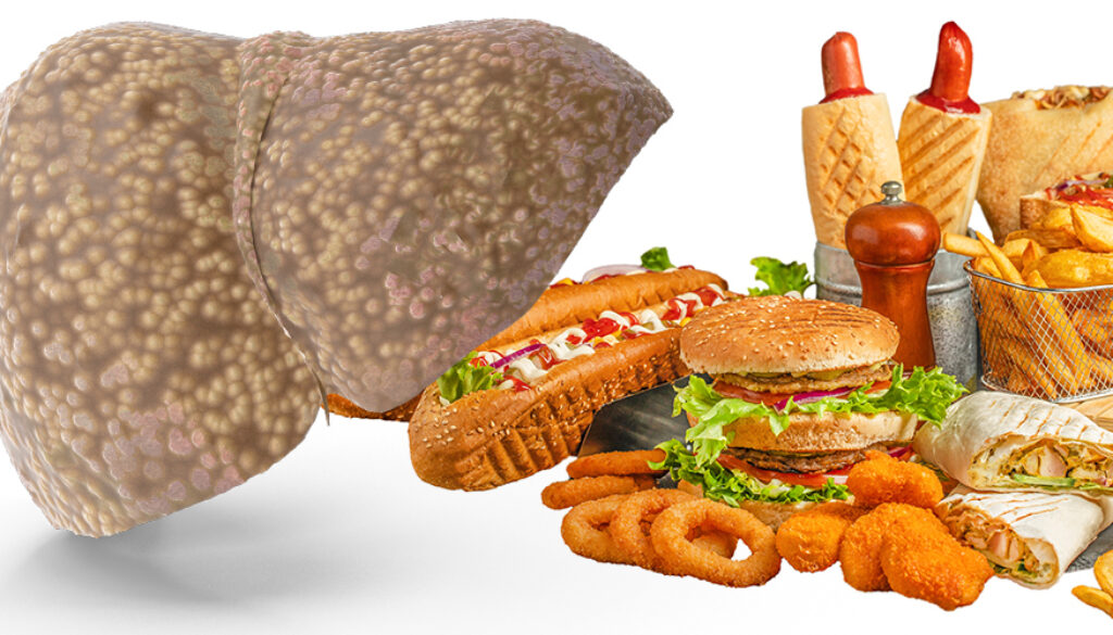 250618-UPF-liver-disease