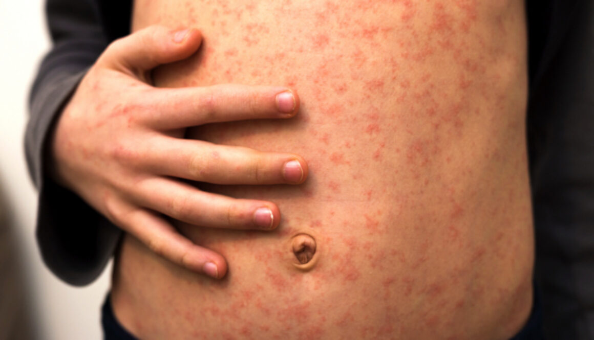 stomach-with-red-rush-spots-from-measles-or-chicken-pox-1