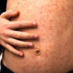 CDC wants plane travel LOCKDOWN for all humans who haven’t received the toxic MEASLES PLANDEMIC VACCINE, even though vaccines don’t work