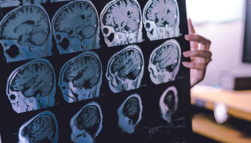 Dementia-Frontotemporal-Film-Mri-Anatomy-Atrophy-Brain