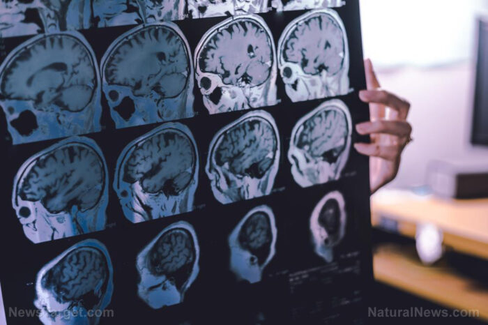 40% higher dementia risk linked to persistent sleep struggles, researchers warn