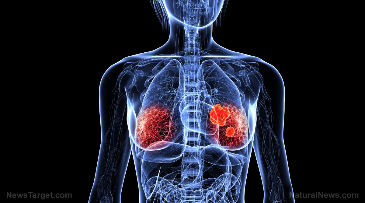 Common chemicals in cosmetics and plastics linked to more aggressive breast cancer, study finds